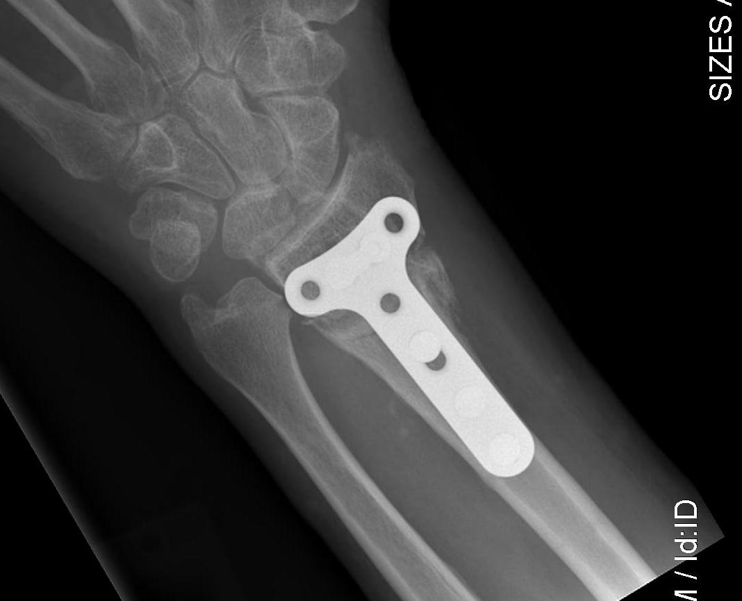 Distal Radial Malunion Dorsal Osteotomy